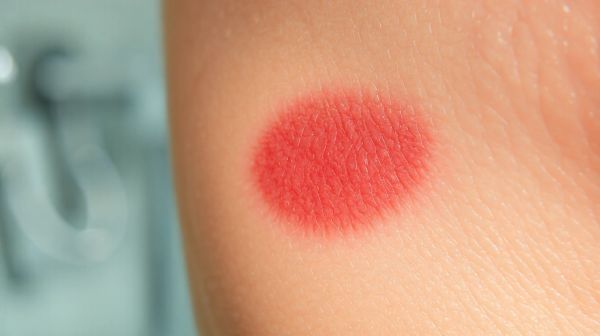 Top solutions pour traiter la cicatrice chéloïde efficacement